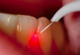 Periodontal Therapy